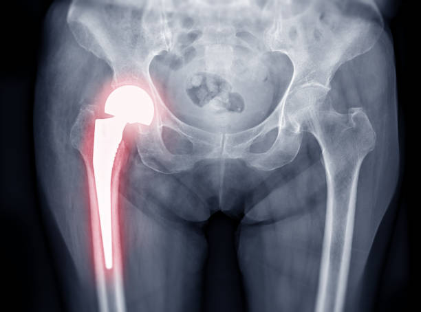 A hip replacement is major surgery, so you should prepare before improving your chances of a favourable outcome and less hip pain.