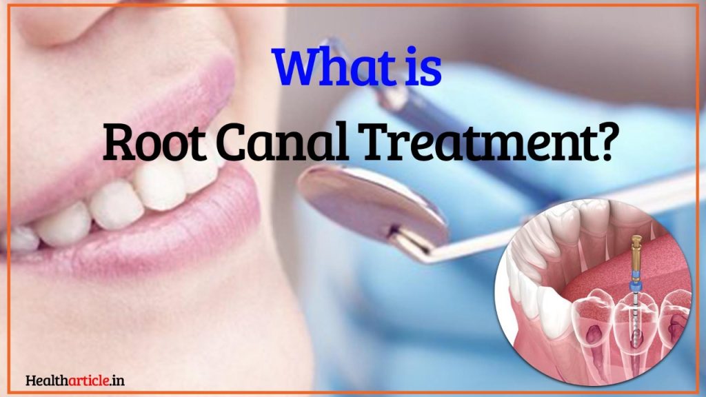 Root canal treatment