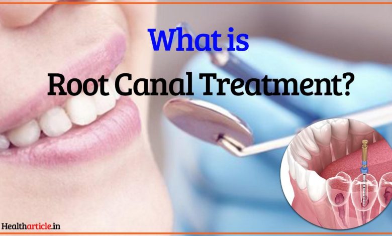 Root canal treatment